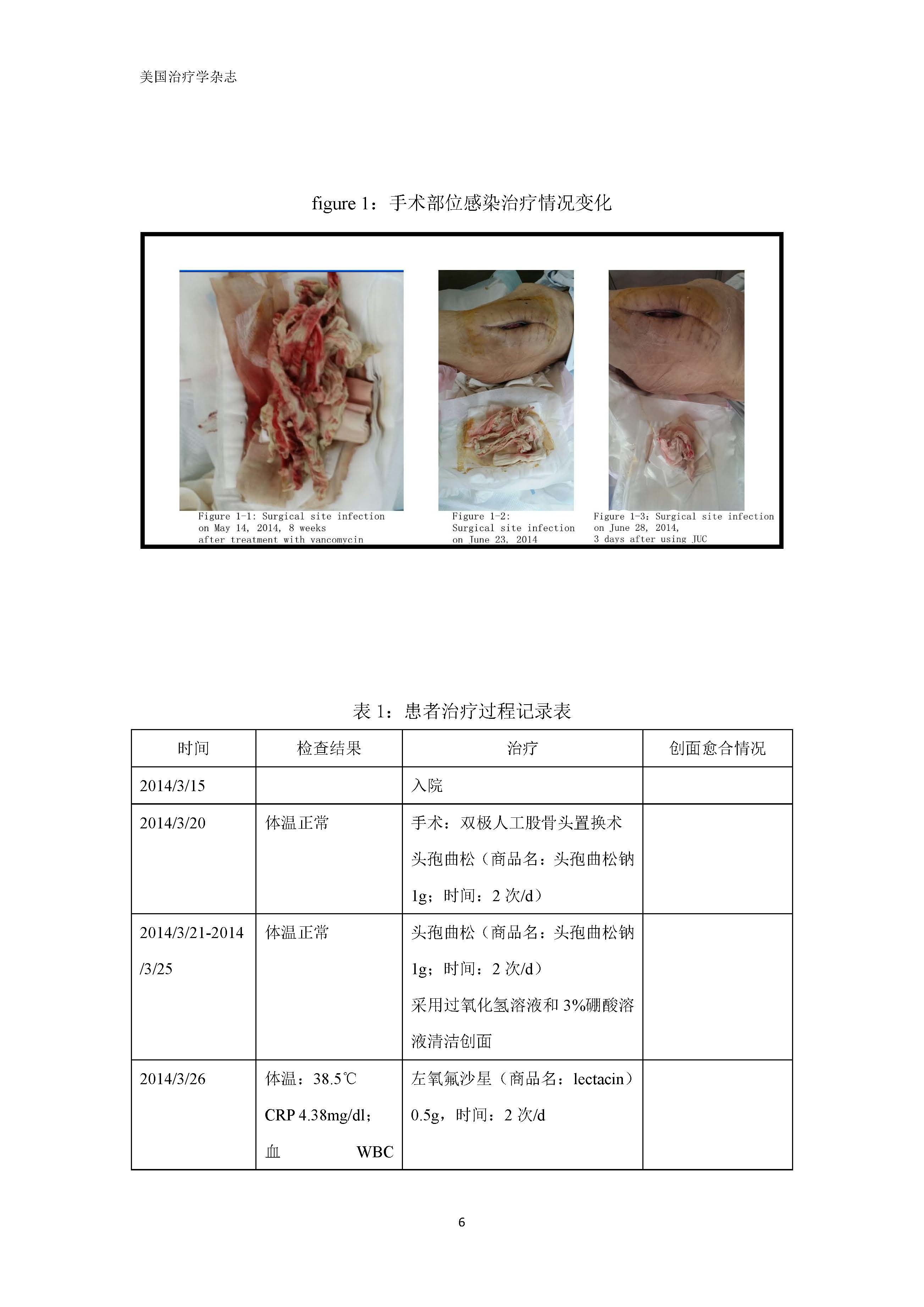 多重耐药菌感染无药可救的挽救案例